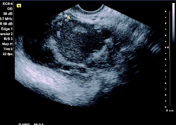 卵巢巧克力囊肿的分型不正确的,怎么辨别是不是卵巢巧克力囊肿