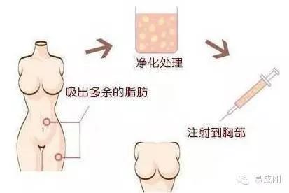 自体脂肪填充——你还在嫌弃堆积的脂肪吗？