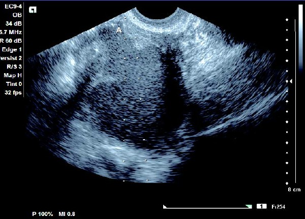 卵巢巧克力囊肿的分型不正确的,怎么辨别是不是卵巢巧克力囊肿