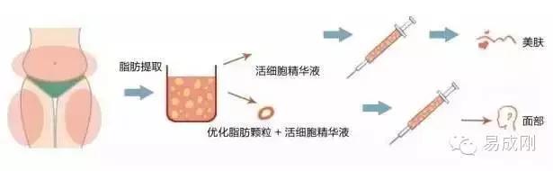 自体脂肪填充——你还在嫌弃堆积的脂肪吗？