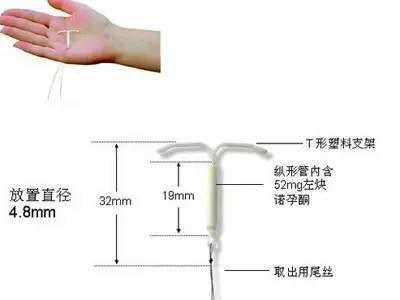 什么样的女性不适合上环,单身女性上环是什么心态