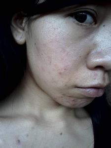 如何去黑头收缩毛孔最简单小方法,毛孔粗大怎么办怎么有效收缩毛孔