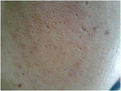 如何去黑头收缩毛孔最简单小方法,毛孔粗大怎么办怎么有效收缩毛孔