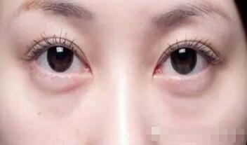 如何去除眼袋皱纹？养成好眼部的护理习惯