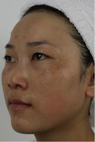 雀斑怎么祛除不花钱1天就好,祛除老年斑色斑雀斑的好方法