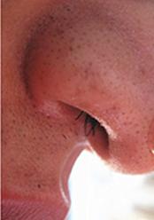 怎么样才能把黑头去掉不用护肤品,学生鼻子上的黑头怎么去掉小妙招