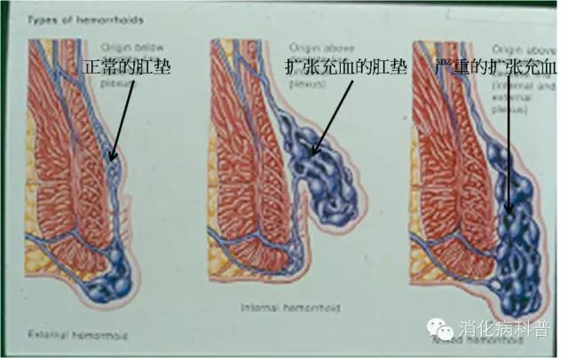 痔疮坐热凳子会传染吗,坐艾灸椅可以治痔疮吗