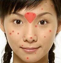 痘痘是身体什么地方出了问题,痘痘告诉你哪里生病了