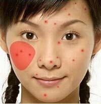 痘痘是身体什么地方出了问题,痘痘告诉你哪里生病了