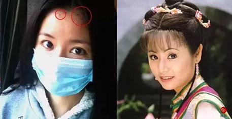 额头长痘痘是油痘肌吗,额头和脸颊两侧长痘痘属于痘肌吗