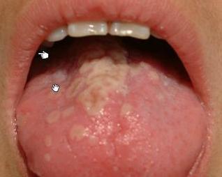 小孩嘴里长疱疹快速消除小窍门,小孩子怎么预防嘴巴长疱疹