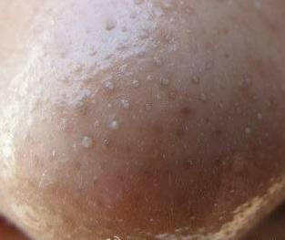 怎么样才能把黑头去掉不用护肤品,学生鼻子上的黑头怎么去掉小妙招