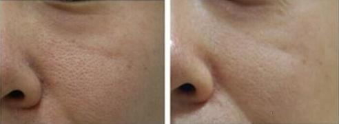 如何改善毛孔粗大,如何改善毛孔粗大问题视频