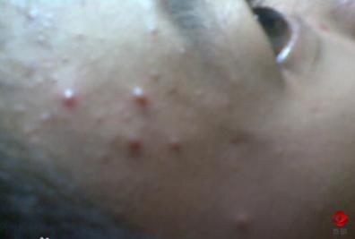 额头长痘痘是油痘肌吗,额头和脸颊两侧长痘痘属于痘肌吗