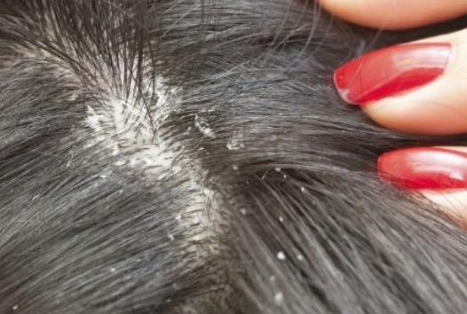 头皮屑很多什么洗发水去头屑,洗发水怎样调出来能减少头屑