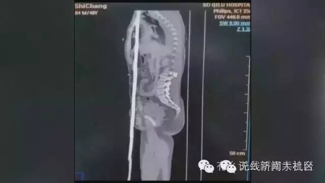 济南男子被1米长钢筋从阴部穿到脑部30名专家开颅开胸开腹手术7小时保住命