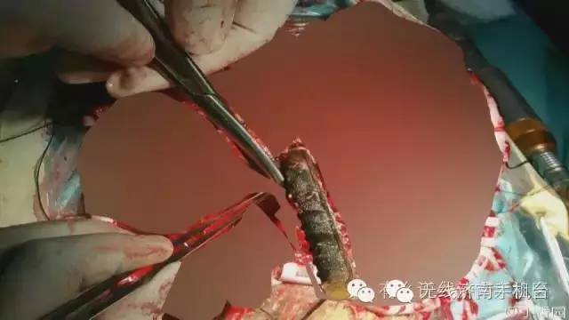 济南男子被1米长钢筋从阴部穿到脑部30名专家开颅开胸开腹手术7小时保住命