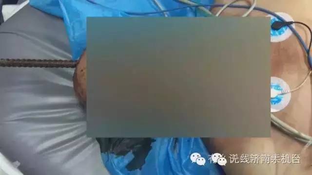 济南男子被1米长钢筋从阴部穿到脑部30名专家开颅开胸开腹手术7小时保住命