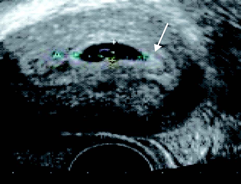 早期妊娠超声主要检查指标视频,输卵管妊娠的超声表现