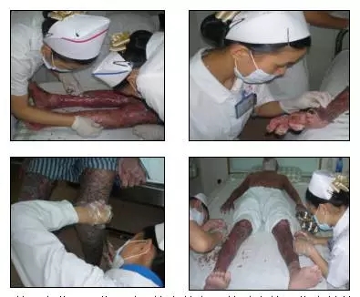 selina烧伤治疗过程,selina烧伤的皮肤恢复好了吗