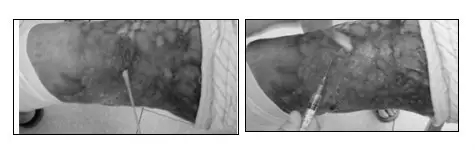 selina烧伤治疗过程,selina烧伤的皮肤恢复好了吗