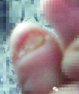 灰指甲脚气脚臭脚脱皮,拉萨治脚气脚臭灰指甲