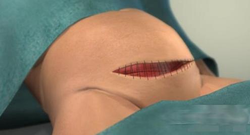 剖腹产女人不可逆的伤害,剖腹产请善待妈妈