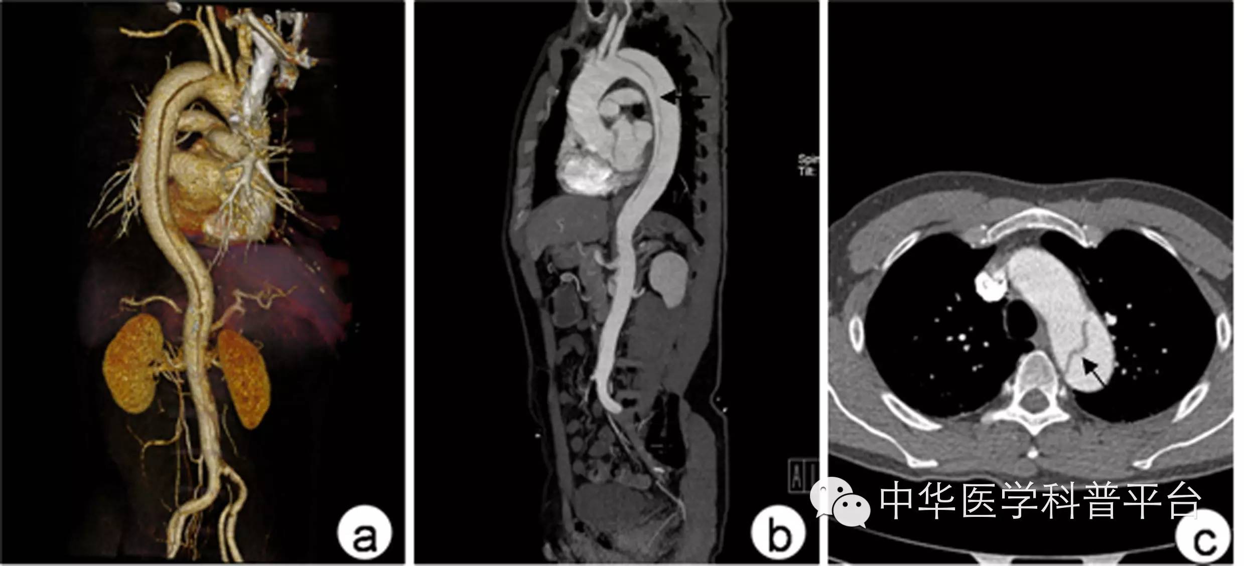 主动脉夹层疼痛位置,主动脉夹层什么症状