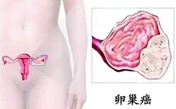 关注|强生爽身粉存致癌嫌疑在美被判天价赔偿夏天来了爽身粉还能用吗？