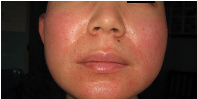 根治红血丝最好的方法,红血丝祛除最有效方法有哪些