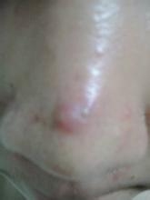 去黑头需谨慎极度后悔,正确去黑头有5个步骤