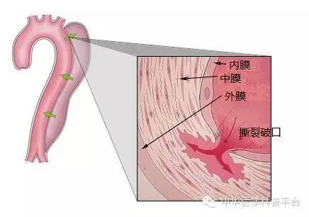 主动脉夹层疼痛位置,主动脉夹层什么症状