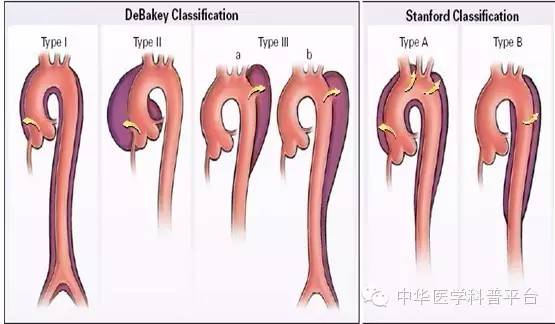 主动脉夹层疼痛位置,主动脉夹层什么症状