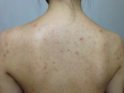 脸蛋上长痘痘的原因和解决方法,脸蛋上长痘痘是什么原因怎么办