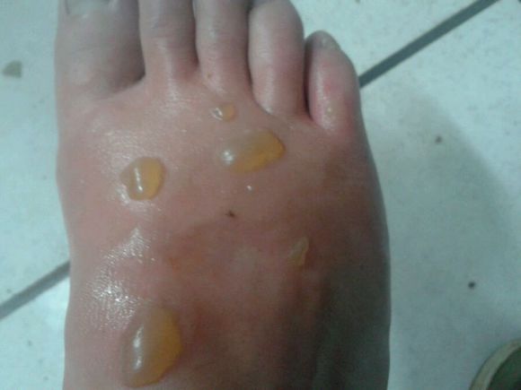 不小心被开水烫了能用冷水冲吗,不小心被开水烫到了怎么处理