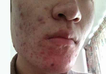 脸蛋上长痘痘的原因和解决方法,脸蛋上长痘痘是什么原因怎么办