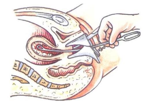 取环手术全过程（附图）