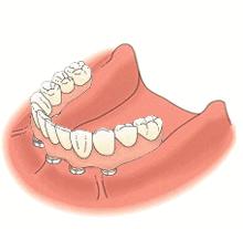 为什么牙科种植牙那么贵,为什么口腔医院都推荐种植牙