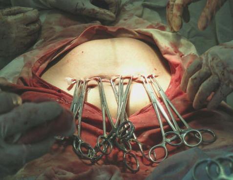 剖腹产的妈妈有多伟大,剖腹产的妈妈最伟大