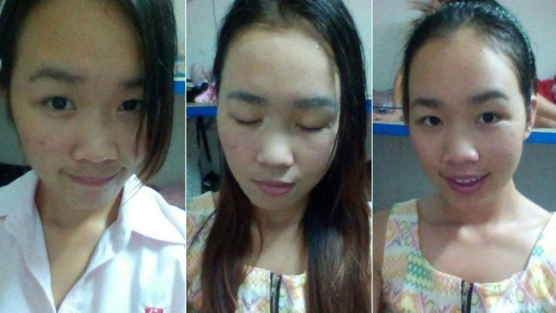 青春痘祛痘痕有效的方法,祛痘痕有效的方法有哪些