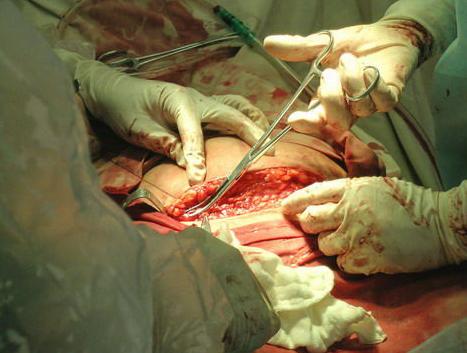 剖腹产的妈妈有多伟大,剖腹产的妈妈最伟大