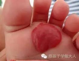 宝宝长雀斑样痣,宝宝长这种痣千万要注意