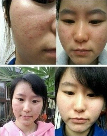 青春痘祛痘痕有效的方法,祛痘痕有效的方法有哪些