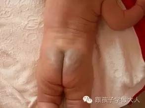 宝宝长雀斑样痣,宝宝长这种痣千万要注意