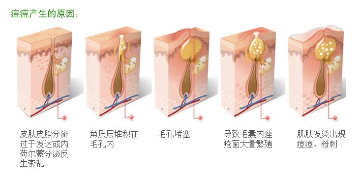 青春痘祛痘痕有效的方法,祛痘痕有效的方法有哪些