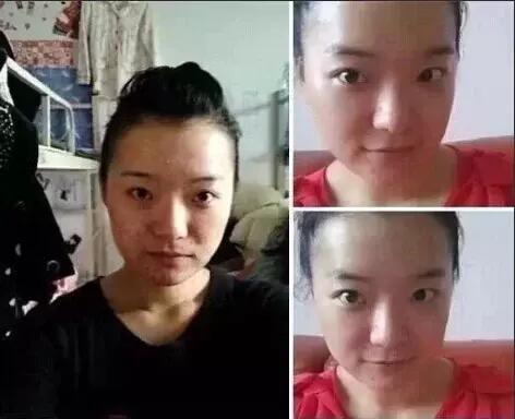 青春痘祛痘痕有效的方法,祛痘痕有效的方法有哪些