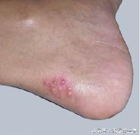 脚脱皮长水泡是哪种真菌感染,趾间糜烂型脚气穿过的鞋怎么处理