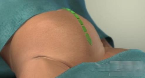 剖腹产女人不可逆的伤害,剖腹产请善待妈妈