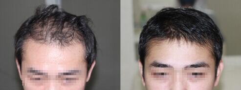 脱发植发青睐雍禾植发,深圳新生植发治疗脱发真的有效吗