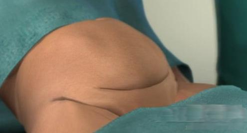 剖腹产女人不可逆的伤害,剖腹产请善待妈妈
